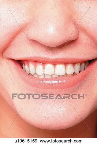 Stock Photo - Braces, Chin, Close-Up, Facial Expression. Fotosearch