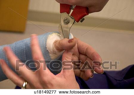 Stock Photo - Clinic nurse making adjustments to cast with cutter for patient with a broken wrist. Fotosearch