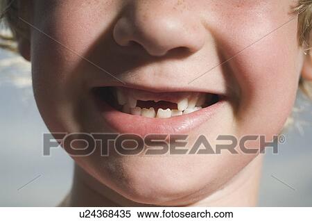 Boy with missing teeth smiling View Large Photo Image Stock Photography - Boy with missing teeth smiling. Fotosearch