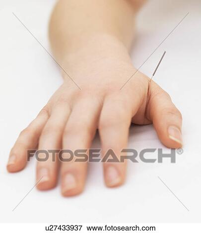 Stock Photo - Woman receiving acupuncture. Fotosearch