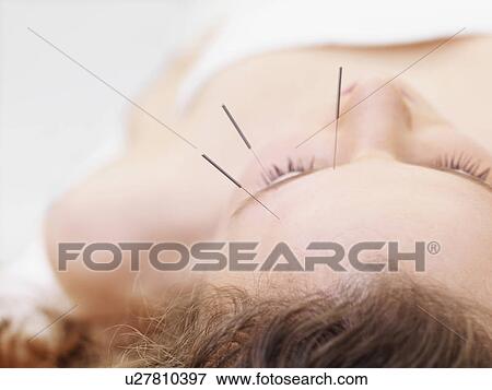 Stock Photo - Woman receiving acupuncture. Fotosearch