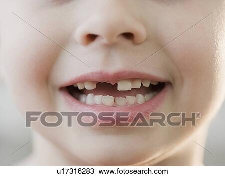 Portrait of boy with missing teeth View Large Photo Image Stock Image - Portrait of boy with missing teeth. Fotosearch