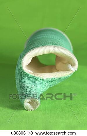 Stock Photo - A removed cast. Fotosearch