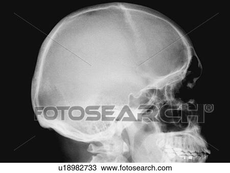 Stock Image - X-ray image of human skull. Fotosearch