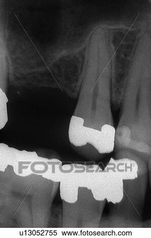 Stock Photography - Dental x-ray. Fotosearch