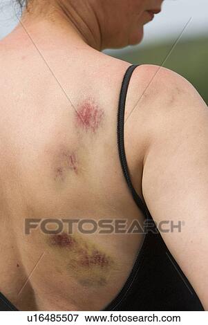 Bruising on woman's right shoulder and back View Large Photo Image Stock Photo - Bruising on woman's right shoulder and back. Fotosearch
