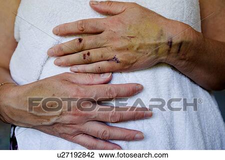 Injuries to a woman's hand and arm View Large Photo Image Stock Image - Injuries to a woman's hand and arm. Fotosearch