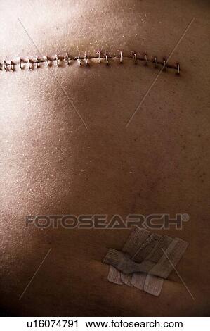 Stitches from surgery View Large Photo Image Stock Image - Stitches from surgery. Fotosearch