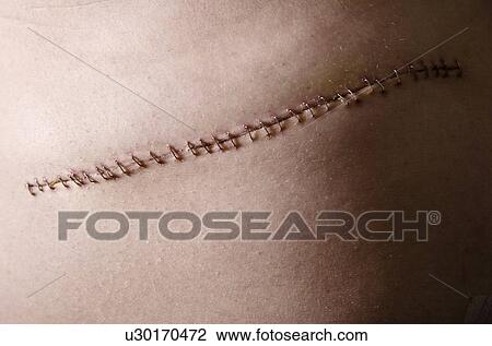 Stitches from surgery View Large Photo Image Stock Image - Stitches from surgery. Fotosearch