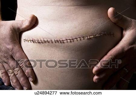 Stock Photo - Stitches from surgery. Fotosearch