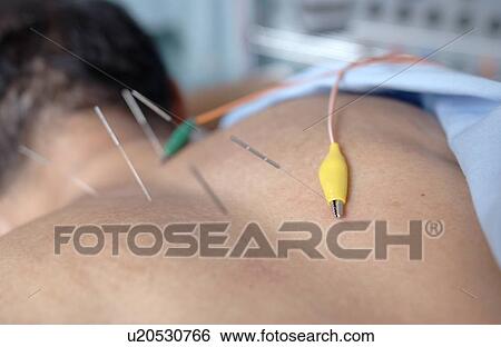 Man getting acupuncture View Large Photo Image Stock Photograph - Man getting acupuncture. Fotosearch