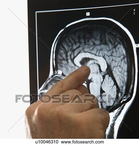 Stock Image - Mid-adult Caucasian male hands pointing at an x-ray.. Fotosearch