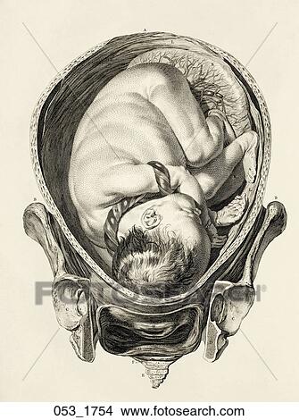 Antique Anatomical Illustration (copper engraving) of full term fetus in utero showing placenta (lateral presentation)., Smellie, 1754 View Large Illustration Stock Illustration - Antique Anatomical Illustration (copper engraving) of full term fetus in utero showing placenta (lateral presentation)., Smellie, 1754. Fotosearch