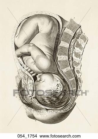 Antique Anatomical Illustration (copper engraving) of full term fetus in utero showing placenta (frontal presentation)., Smellie, 1754 View Large Illustration Stock Illustration - Antique Anatomical Illustration (copper engraving) of full term fetus in utero showing placenta (frontal presentation)., Smellie, 1754. Fotosearch