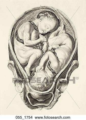 Antique Anatomical Illustration (copper engraving) of full term twins in utero., Smellie, 1754 View Large Illustration Stock Illustration - Antique Anatomical Illustration (copper engraving) of full term twins in utero., Smellie, 1754. Fotosearch