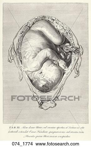 Antique Anatomical Illustration (copper engraving) showing full term fetus in utero (lateral presentation). Hunter., 1774 View Large Illustration Stock Illustration - Antique Anatomical Illustration (copper engraving) showing full term fetus in utero (lateral presentation). Hunter., 1774. Fotosearch